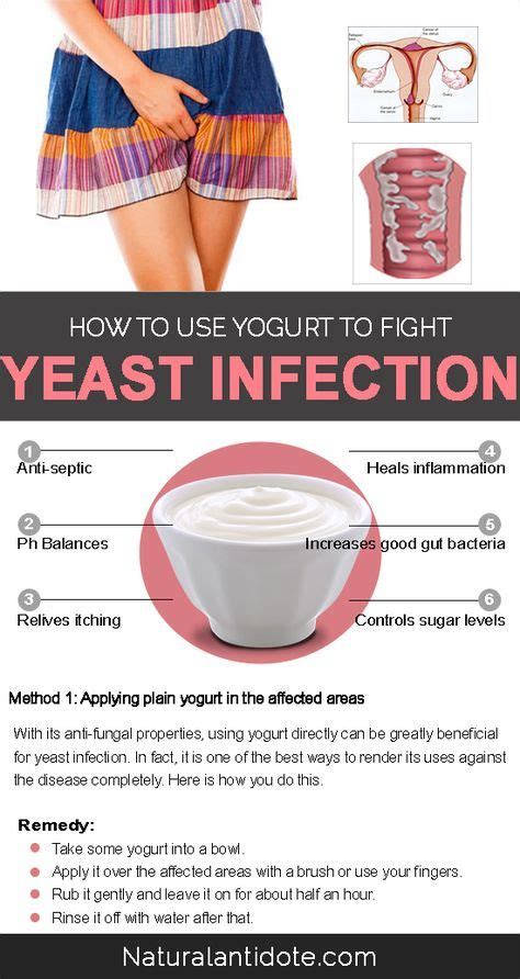 Applied to the skin it is used for fungal skin infections such as tinea, cutaneous candidiasis, pityriasis versicolor, dandruff, and seborrheic dermatitis. 10 Natural Ways to Use Yogurt For Yeast Infections | Yeast ...