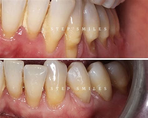 Gum Tissue Graft Surgery Procedure Causes Techniques And More