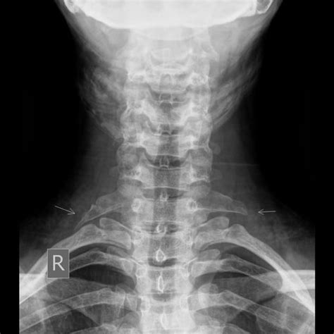 Cervical Ribs Radiology Case