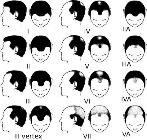 The Norwood Scale Understanding Hair Loss Stages Neo