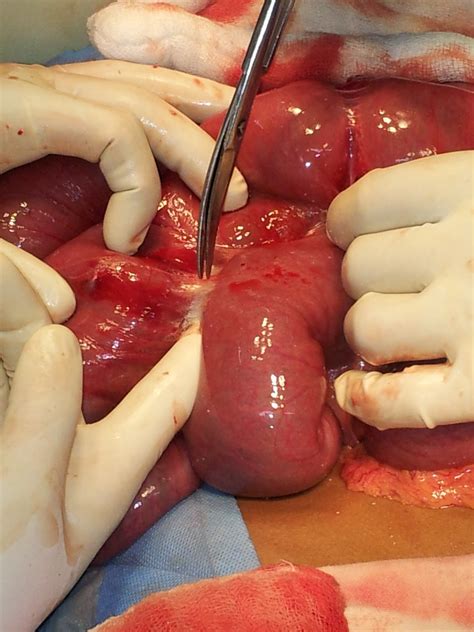 Intestinal obstruction symptoms and signs. General Surgery Clinics ~ A Surgeon's Blog: Intestinal ...