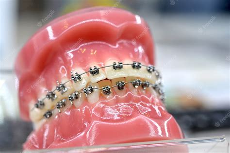 Premium Photo Braces On Artificial Teeth