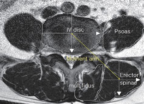 Lumbar Spine Muscles Anatomy Mri