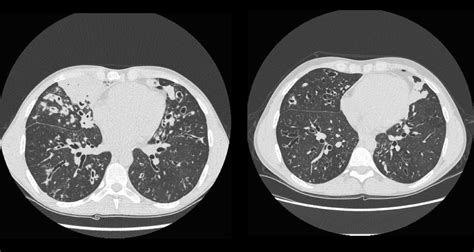 Time To Get Serious About The Detection And Monitoring Of Early Lung