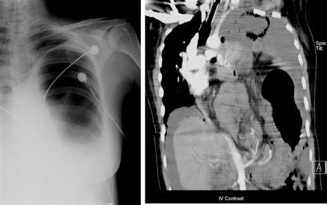 Diaphragmatic Hernia Radiology Cases