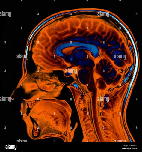 Coloured Magnetic Resonance Imaging MRI Scan Of A Sagittal Section Through A Patient S Head