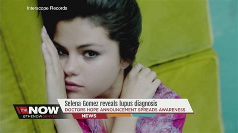 Lupus Patients Hope Selena Gomez Announcement Increases Awareness