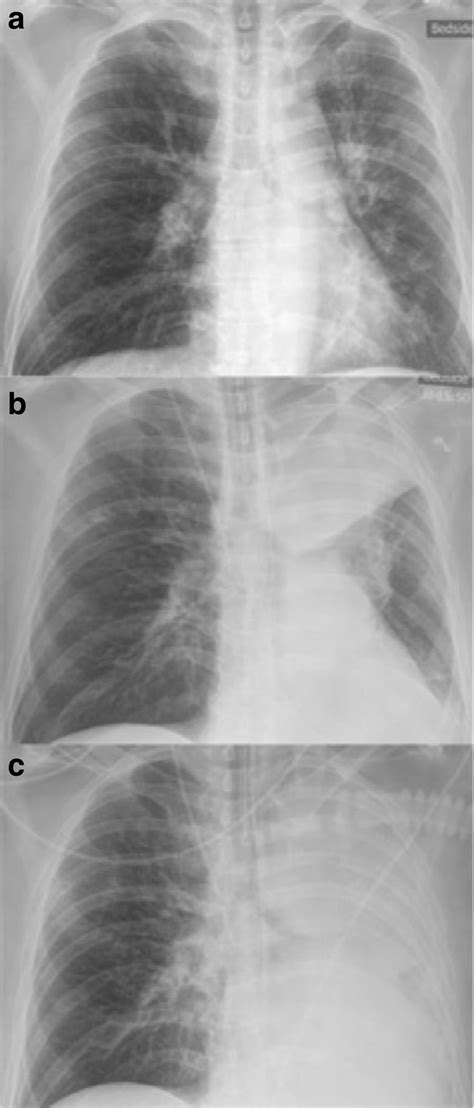 Serial Chest Radiographs During The First Day Showing A Progressive