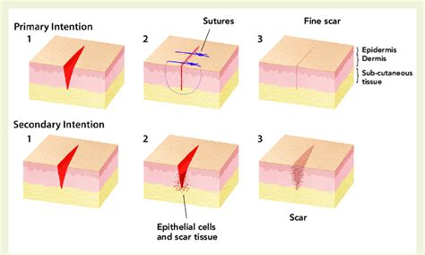 Difference In Wound Healing Between Primary And Secondary Intention