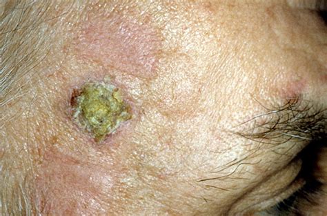 Early Signs Of Skin Cancer On Face