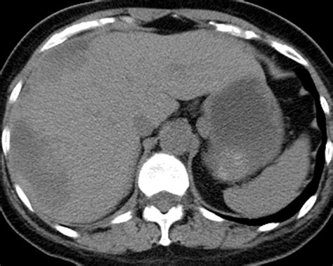 Liver Atlas Diagnosis Hematoma