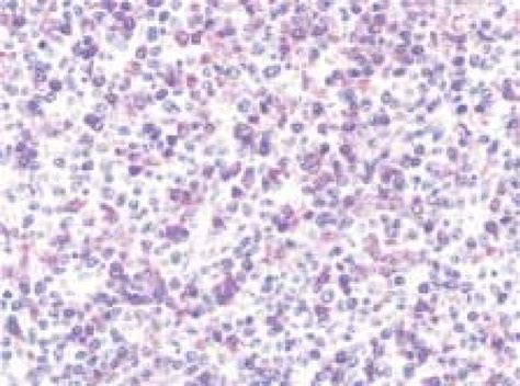 T Cellhistiocyte Rich Large B Cell Lymphoma The Majority Of Cells Are