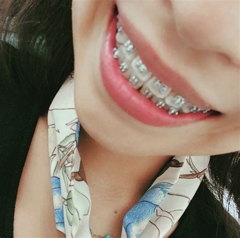 Pin By Evil H On Braces In Perfect Teeth Metal Braces Braces Girls