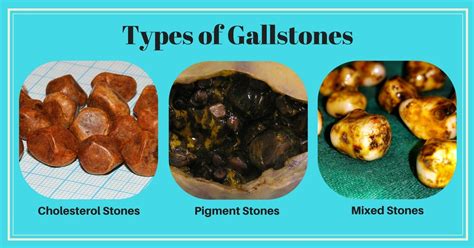 A case of a 25 year old pregnant woman, whose gall stones were out of a homeopathic treatment.after this she conceived and now , mother and child. Gallbladder Removal Surgery in Chennai | Gallstones Treatment