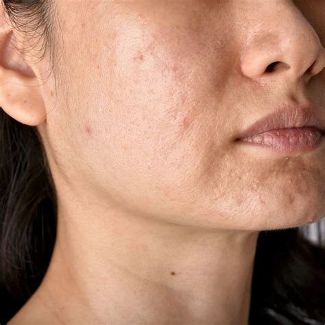 Dermatologist Recommended Treatments For Acne Scars