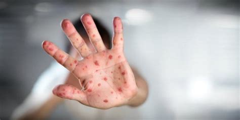 Di seingapura, ditemukan seorang warga negara nigeria yang dilansir dari klik dokter, penyakit cacar monyet atau monkeypox adalah penyakit zoonosis, dimana virus penyebabnya dapat menyebar dari hewan ke. Apa Itu Vaksin Cacar Monyet? Bagaimana Pencegahannya ...