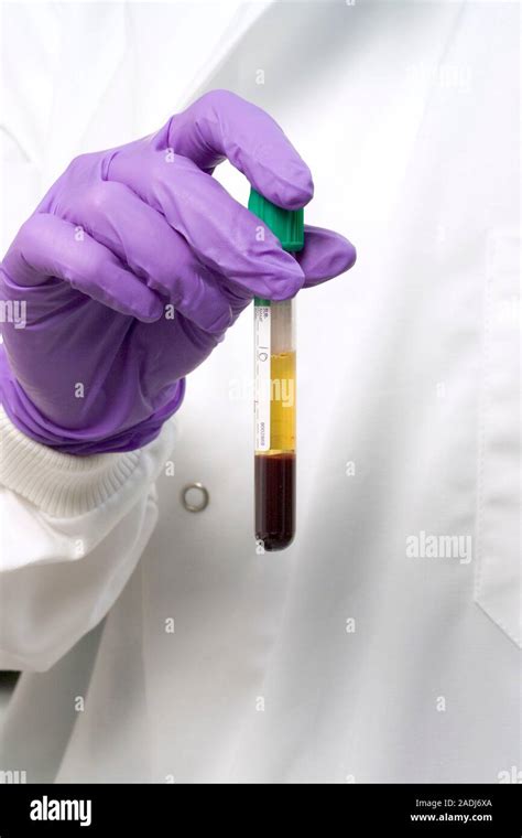 Centrifuged Blood Technician Holding A Vacutainer Tube Filled With