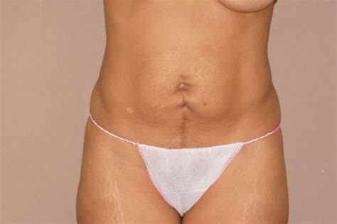Bauchdeckenstraffung Vorher Und Nachher Bilder Abdominoplastik