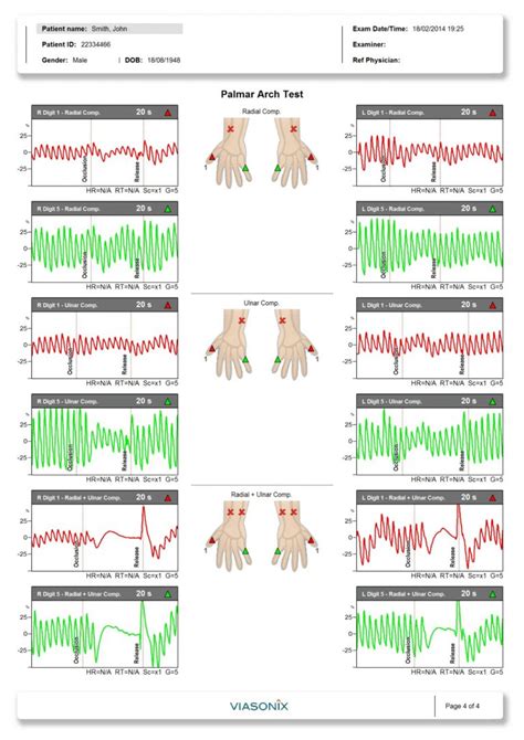 Thoracic Outlet Syndrome And Palmar Arch Test Medtech Edge