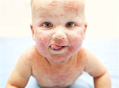 5 Allergies Cutanées Courantes De Bébé Et Leurs Causes