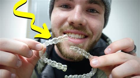 Invisalign Review What You Dont Know After 6 Months Youtube