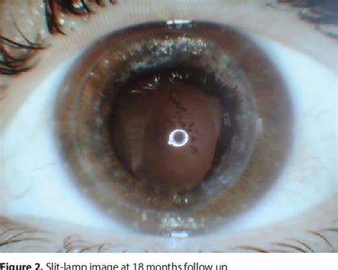 Figure 1 From Toxic Anterior Segment Syndrome Following Deep Anterior Lamellar Keratoplasty