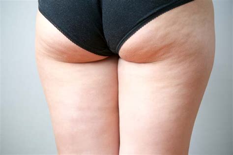 Cellulite Causes Treatment Prevention Medical News Today