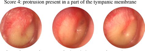 figure 12 from clinical practice guidelines for the diagnosis and management of acute otitis