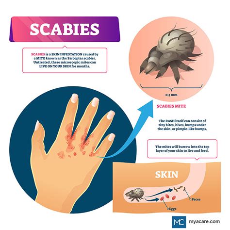 Scabies Vs Eczema Mya Care
