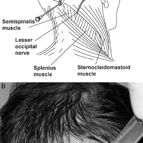 Occipital Nerve Block Technique