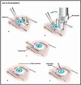 Lasik Eye Surgery Procedure Pictures