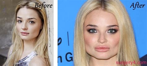 Emma Rigby Plastic Surgery Photos Before After Surgery My XXX Hot Girl