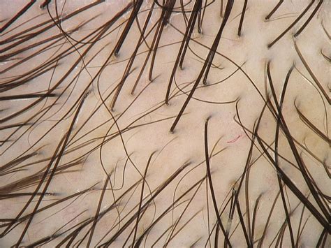Update On Female Pattern Hair Loss Advances In Diagnosis And Treatment