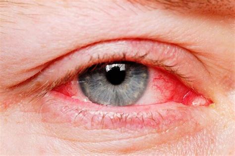 Eyelid Redness Causes Symptoms Inflamed Dry Itchy Swollen Red