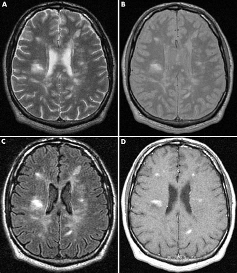 Axial magnetic resonance imaging (mri) of a 30 year old man with relapsing remitting multiple sclerosis (ms) showing multiple periventricular lesions: Imaging in multiple sclerosis | Journal of Neurology ...