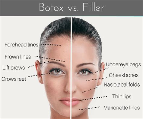 Sofort ergebnisse aus mehreren quellen! JUVEDERM - Simply Radiant