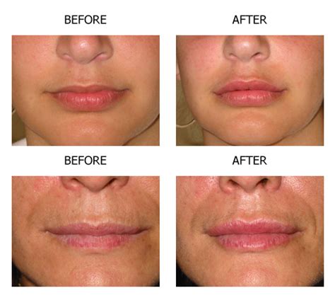 Lip Fillers Before And After