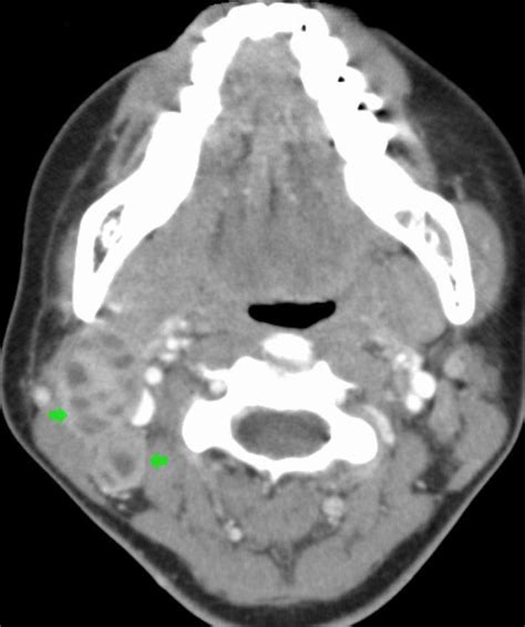 Tuberculous Cervical Lymphadenopathy Radrounds Radiology Network