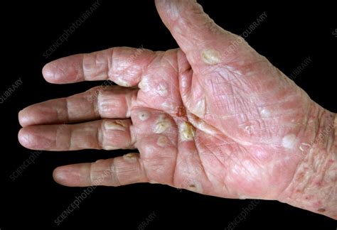 Bullous Pemphigoid On A Womans Hand Stock Image C0586442
