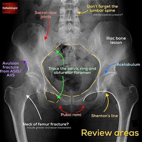 Want To Learn A System For Reviewing A Pelvic X Ray Read On To