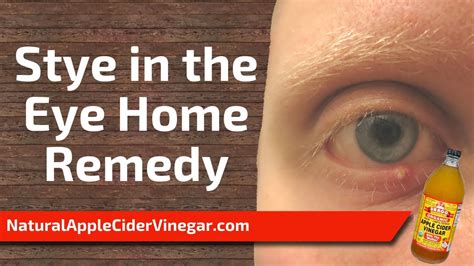 the best home remedy for stye in the eye youtube