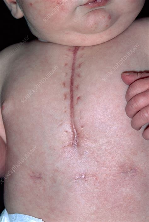 Scar After Infant Heart Surgery Stock Image M Science