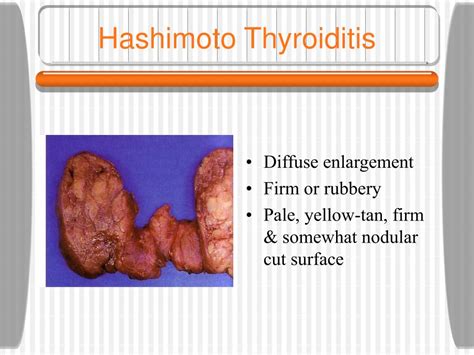Ppt Pathology Of The Thyroid Gland Powerpoint Presentation Free
