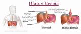 Images of Hiatal Hernia Diagnosis And Treatment