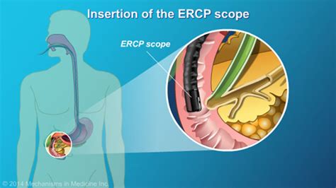 Slide Show Understanding Ercp