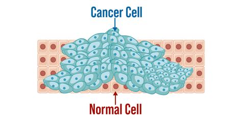 What Is Cancer Introduction Types Stages Treatment Geeksforgeeks