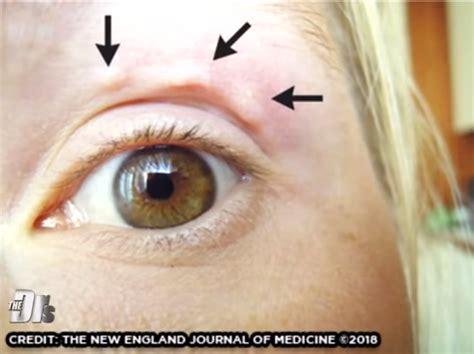 Itchy Lump On Womans Face Turns Out To Be A 6 Inch Worm