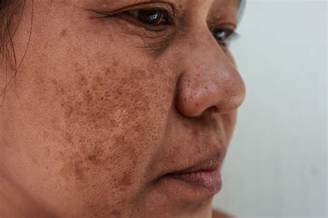 Skin Discoloration Causes And Treatments 2023