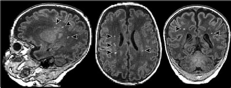 Punctate White Matter Lesions Each Case Was Reviewed By Two