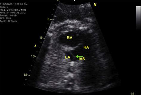 Fetal Echocardiogram Demonstrating Finding Of Hypoplastic Left Heart